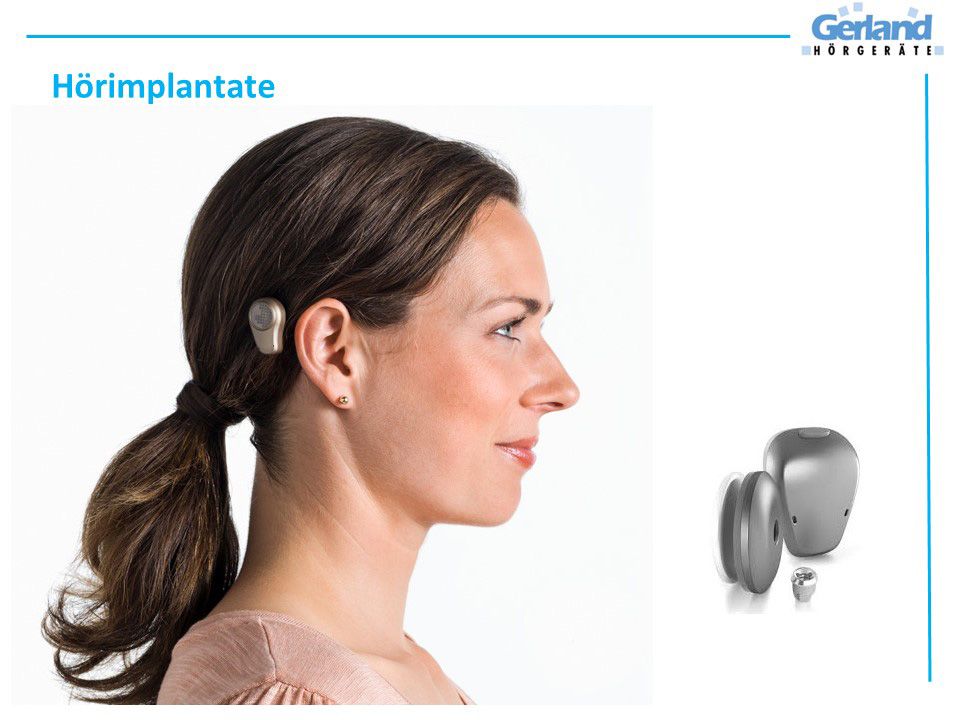 Hear system. ADHEAR слуховой аппарат. Слуховой аппарат Baha. Слуховой аппарат с костной проводимостью ADHEAR. Неимплантируемый слуховой аппарат Baha.